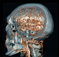 뇌혈관 질환과 뇌기능 검사1