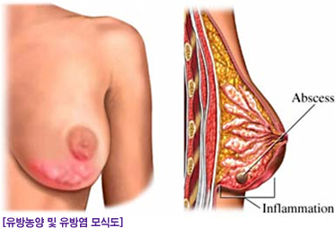 유방농양 및 유방염 모식도
