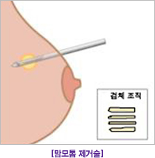 맘모톰 제거술