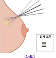 침생검