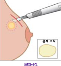 절제생검
