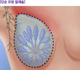 단순 유방 절제술