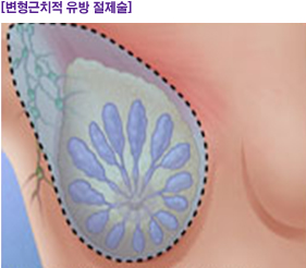 변형근치적 유방 절제술
