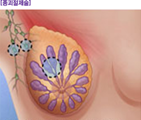 종괴절제술