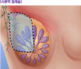 사분역 절제술