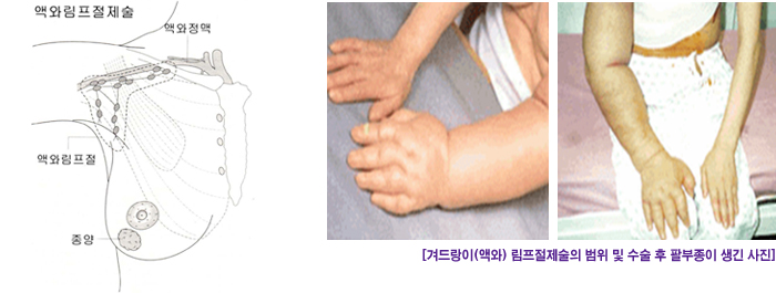 겨드랑이(액와) 림프절제술의 범위 및 수술 후 팔부종이 생긴 사진