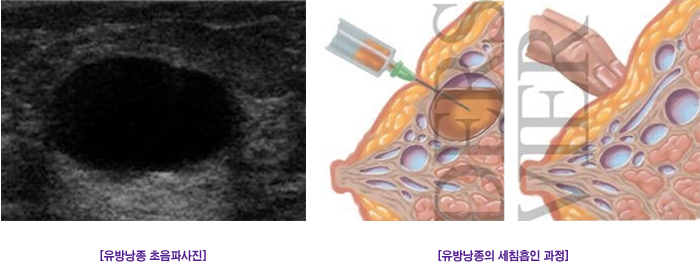 유방낭종 초음파사진, 유방낭종의 세침흡인 과정